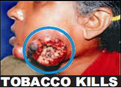 India 2011 Health Effects Mouth (Smokeless Tobacco Products) - diseased organ, gross 2